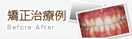 矯正治療例(症例)|富士見市 歯科