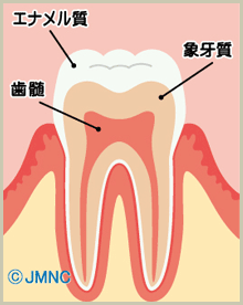 虫歯の仕組み