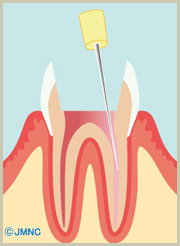 歯の神経の治療