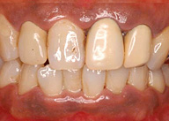歯周病　初期症状